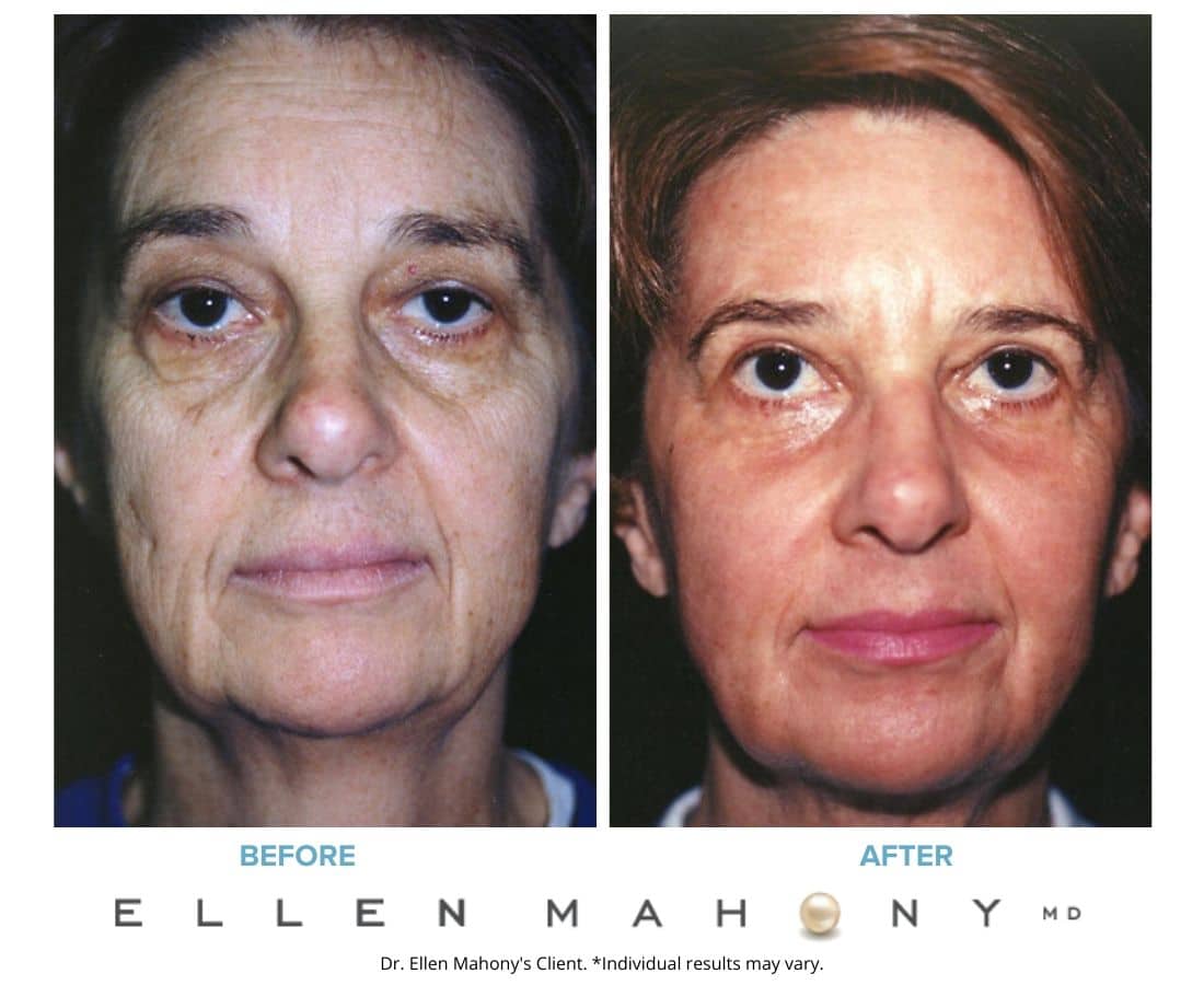 Skin Resurfacing Before & After Images Westport CT