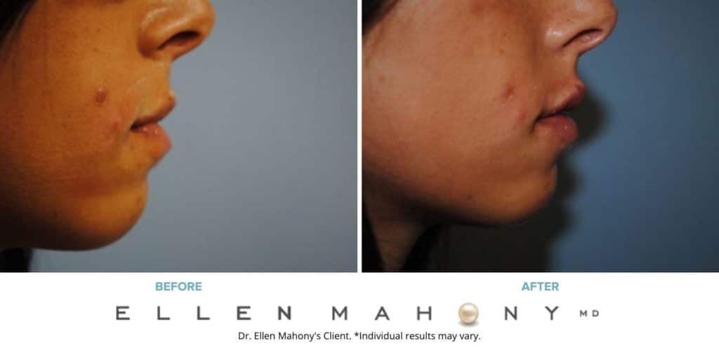 Injectable Fillers Westport CT