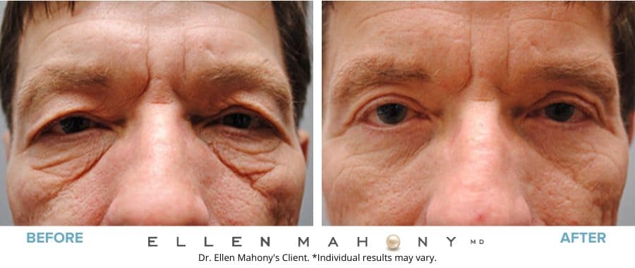 Eyelid Surgery for Men Westport CT | Dr. Ellen Mahony