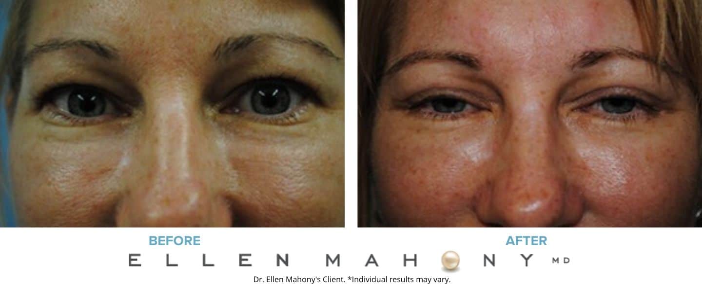 Eyelid Surgery | Westport CT | Dr. Ellen Mahony