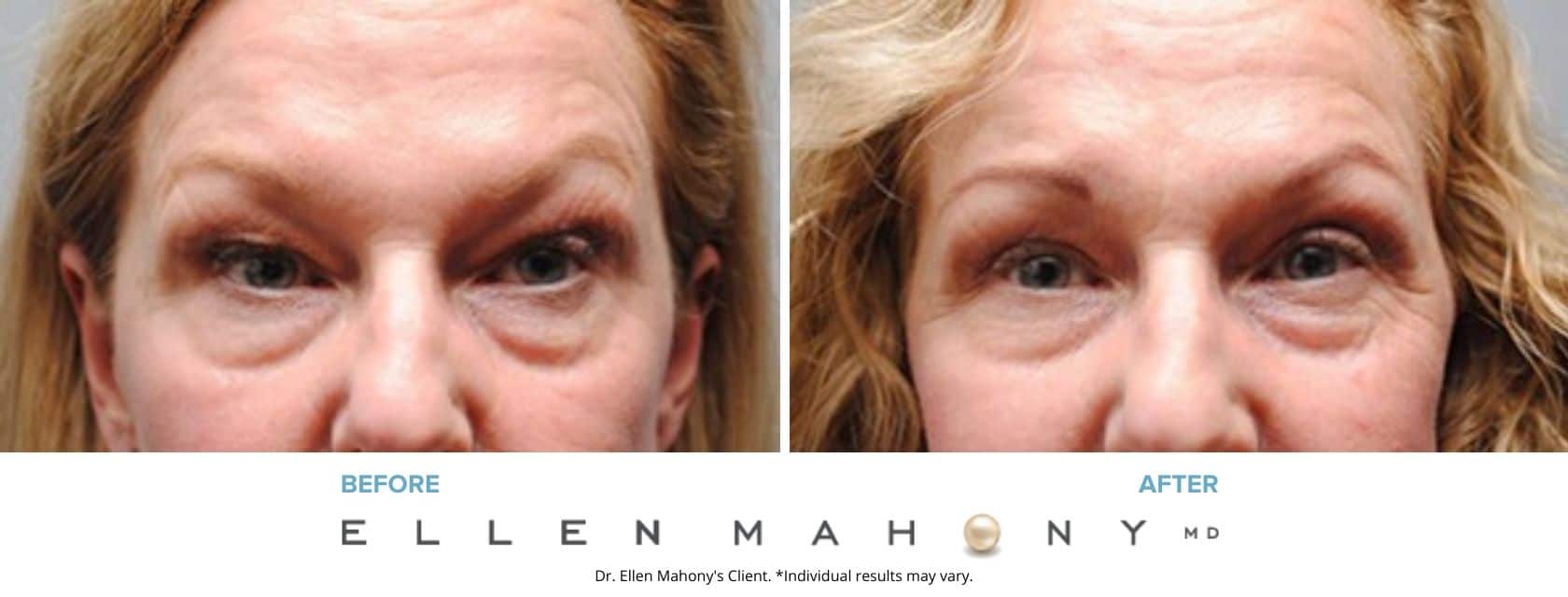 Eyelid Surgery | Westport CT | Dr. Ellen Mahony