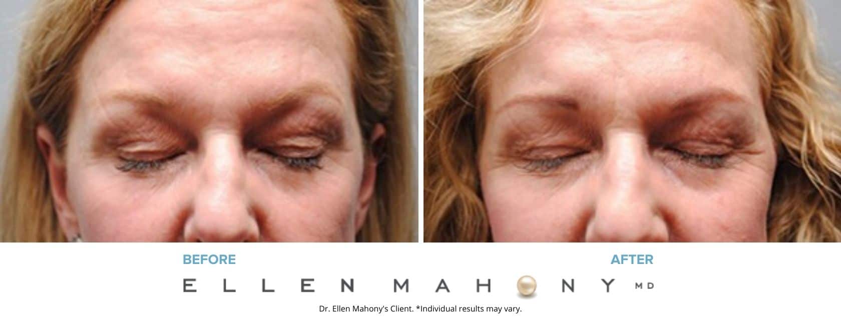 Eyelid Surgery | Westport CT | Dr. Ellen Mahony