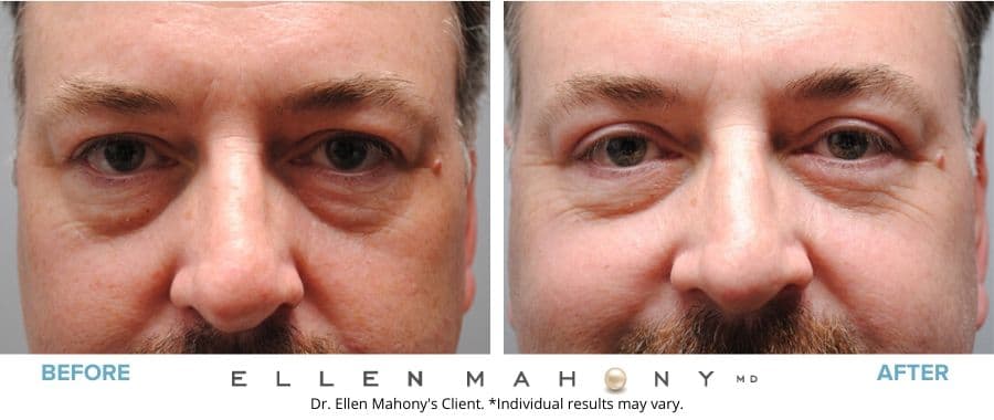 Eyelid Surgery for Men Westport CT | Dr. Ellen Mahony