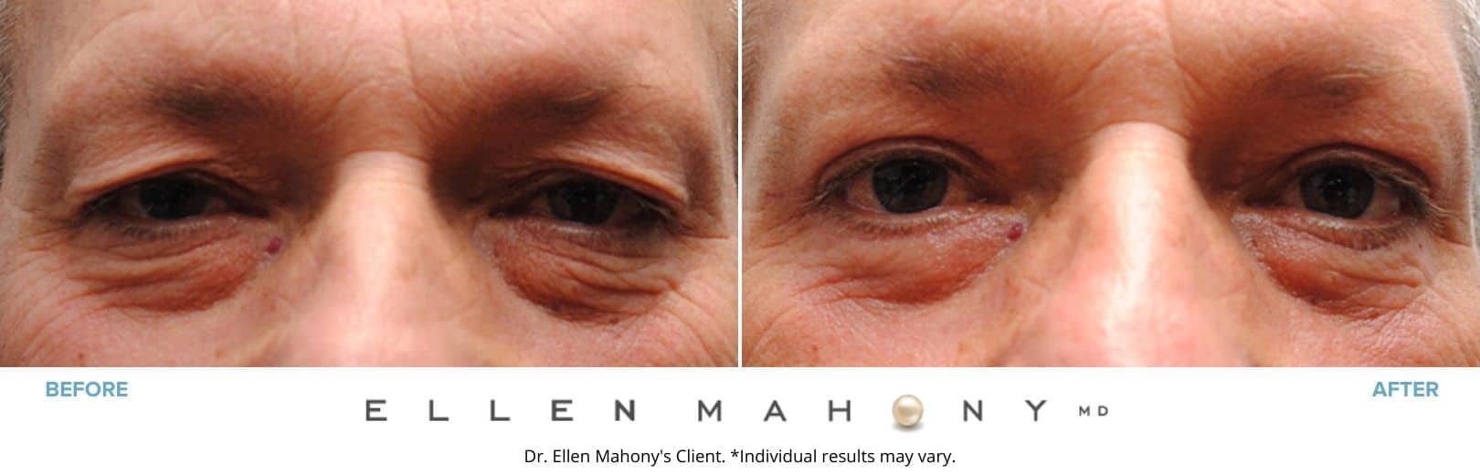 Eyelid Surgery for Men Westport CT | Dr. Ellen Mahony