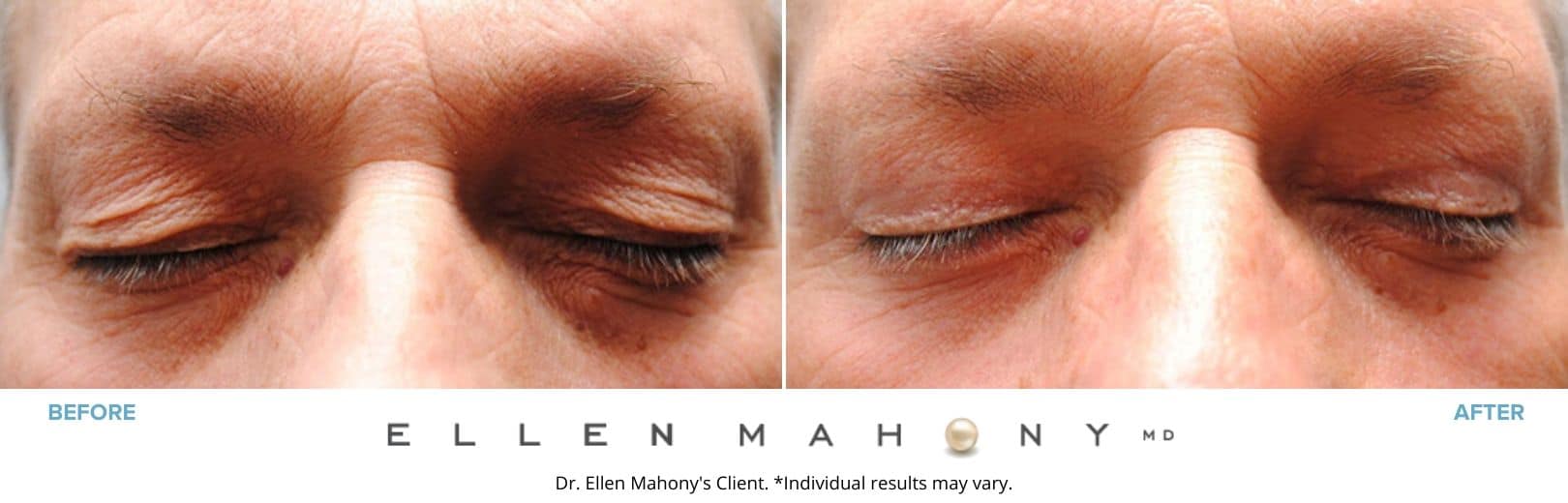 Eyelid Surgery for Men Fairfield County CT