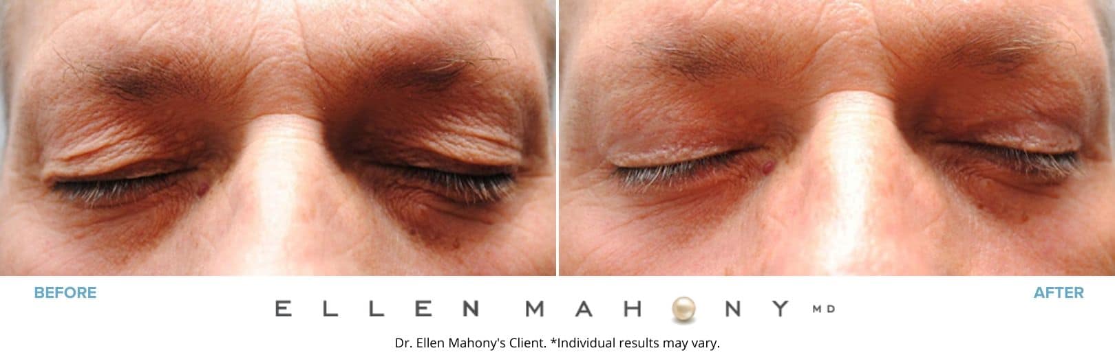 Eyelid Surgery for Men Westport CT | Dr. Ellen Mahony