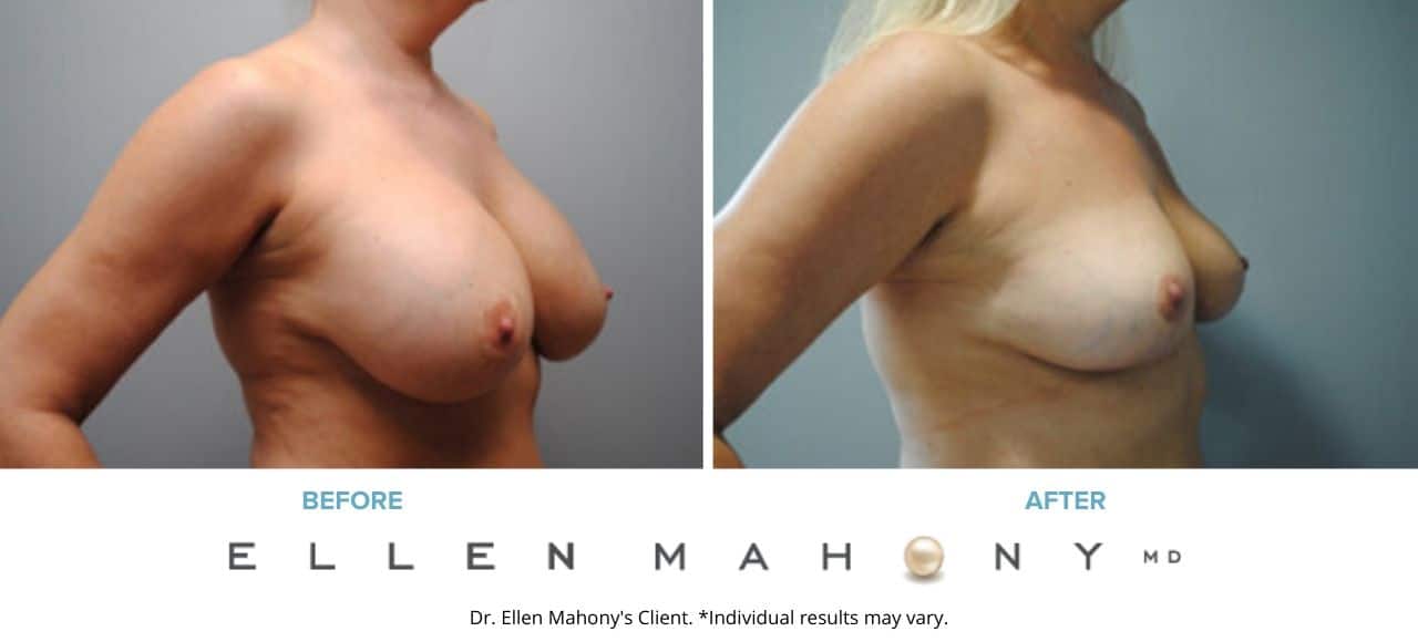 Corrective Breast Surgery | Westport CT | Dr. Ellen Mahony