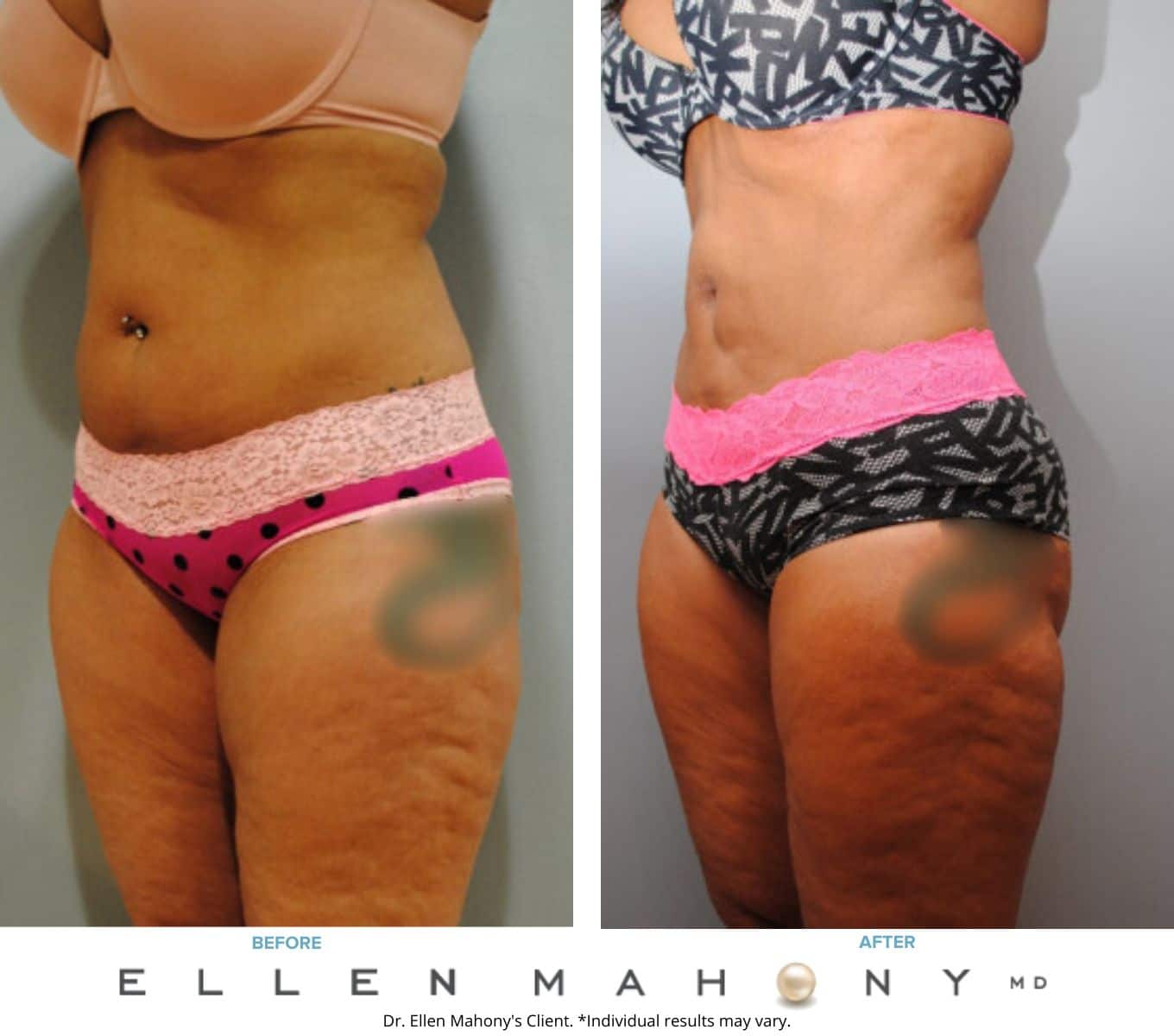 Liposuction Westport CT | Dr. Ellen Mahony