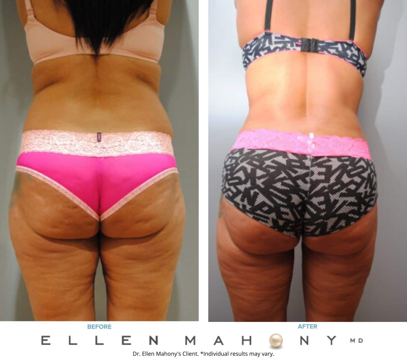 Liposuction Westport CT | Dr. Ellen Mahony