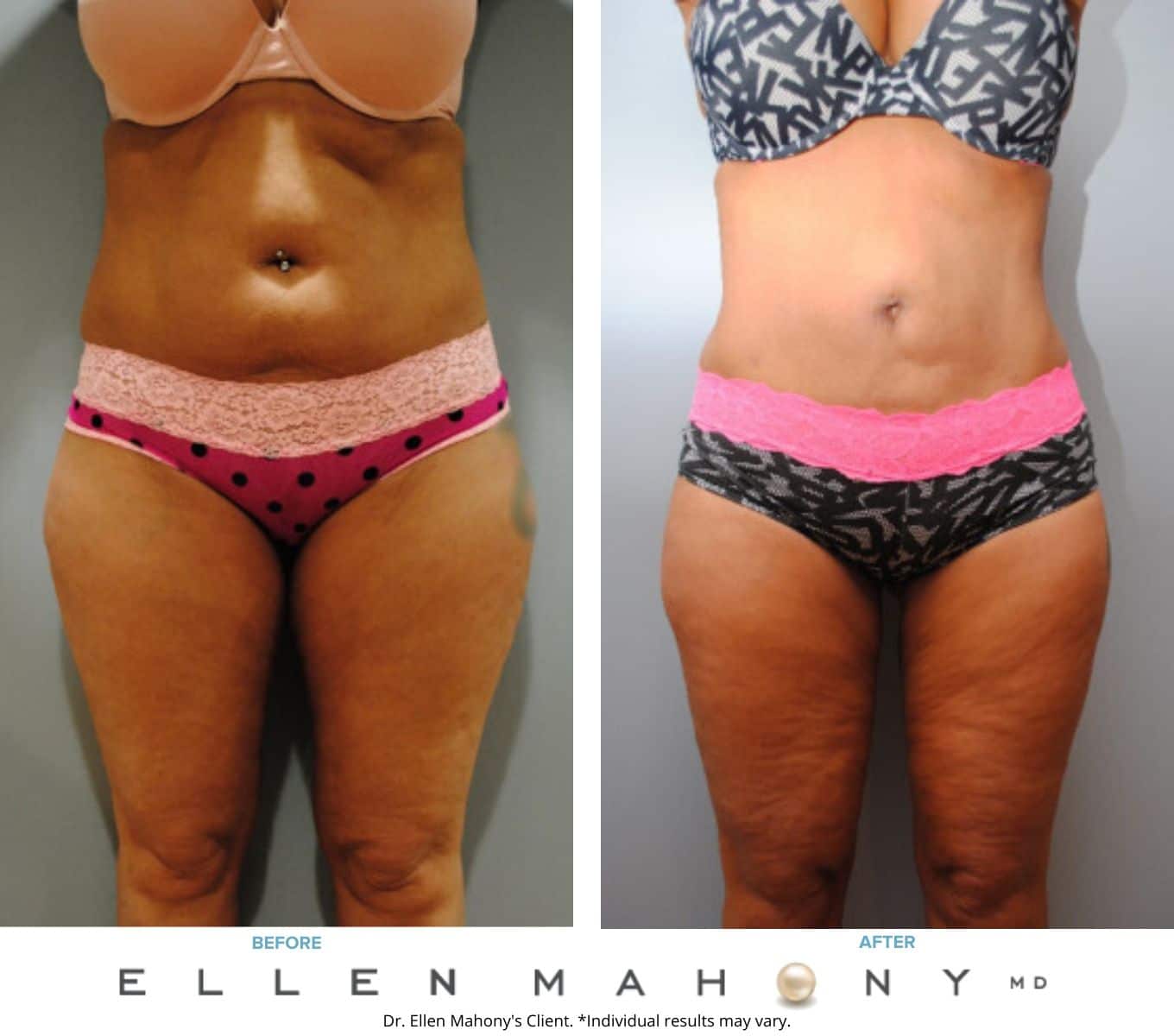 Liposuction Westport CT | Dr. Ellen Mahony