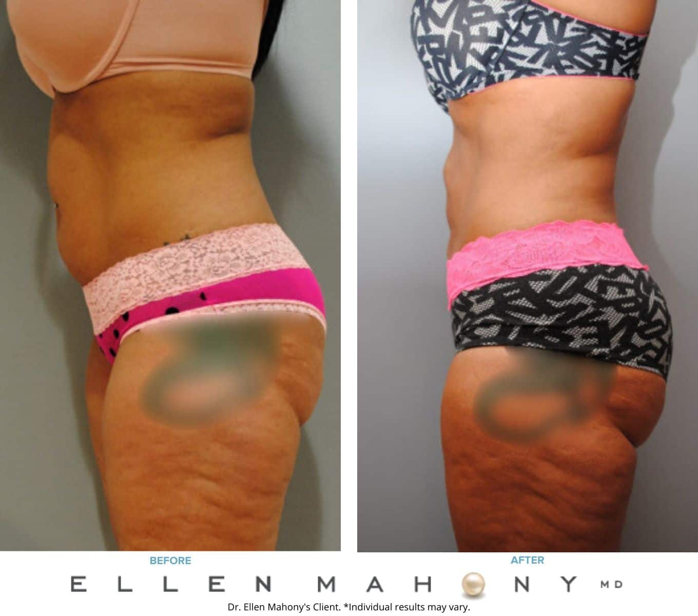 Liposuction Westport CT | Dr. Ellen Mahony