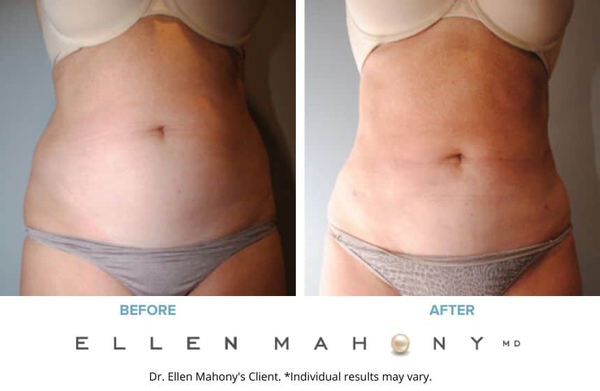 Liposuction Westport CT | Dr. Ellen Mahony