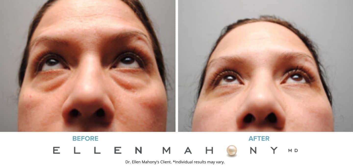 Eyelid Surgery | Westport CT | Dr. Ellen Mahony