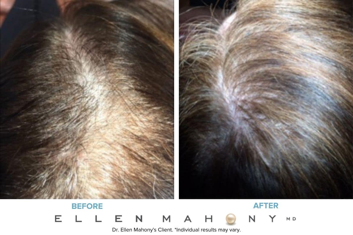 PRP Hair Restoration Case | Westport CT | Dr. Ellen Mahony
