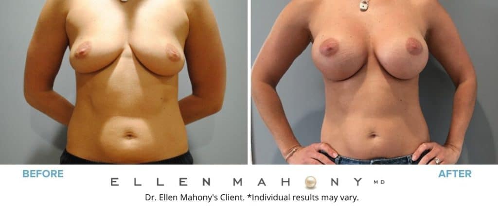 IDEAL Breast Implants | Westport CT | Dr. Ellen Mahony