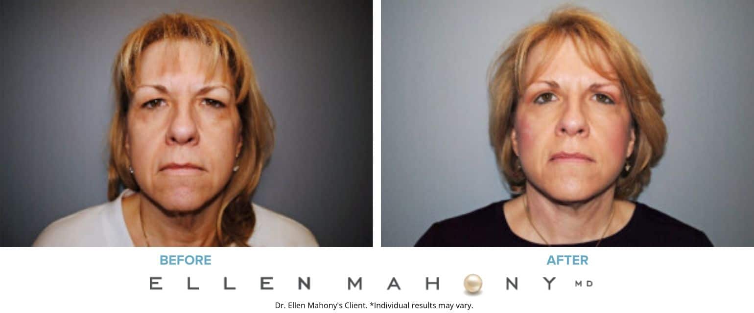 Face Lift/Neck Lift | Westport CT | Dr. Ellen Mahony