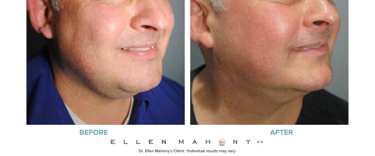 Liposuction for Men Westport CT | Dr. Ellen Mahony