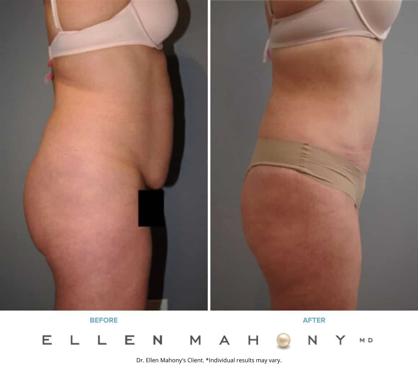 Liposuction Westport CT | Dr. Ellen Mahony