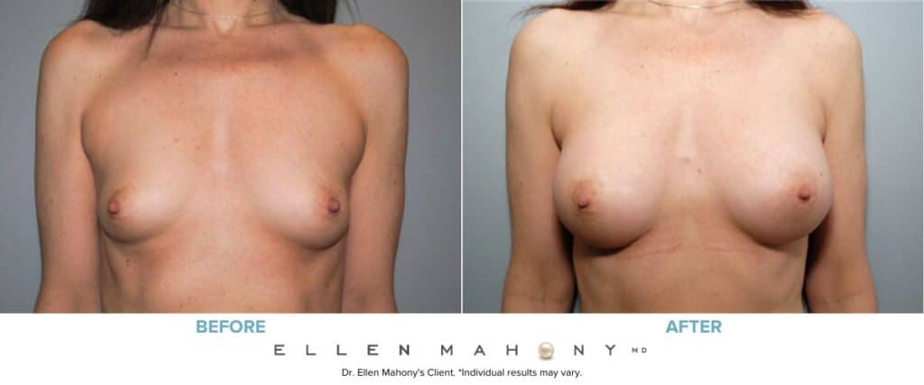 IDEAL Breast Implants | Breast Augmentation | Westport CT | Dr. Ellen Mahony