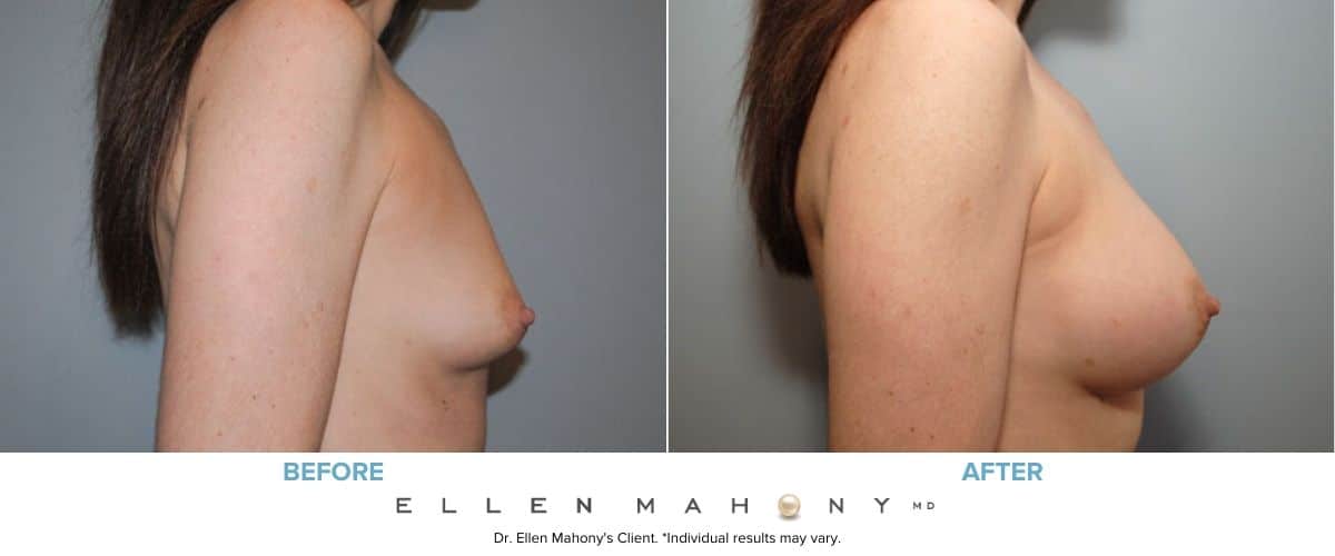 IDEAL Breast Implants | Breast Augmentation | Westport CT | Dr. Ellen Mahony
