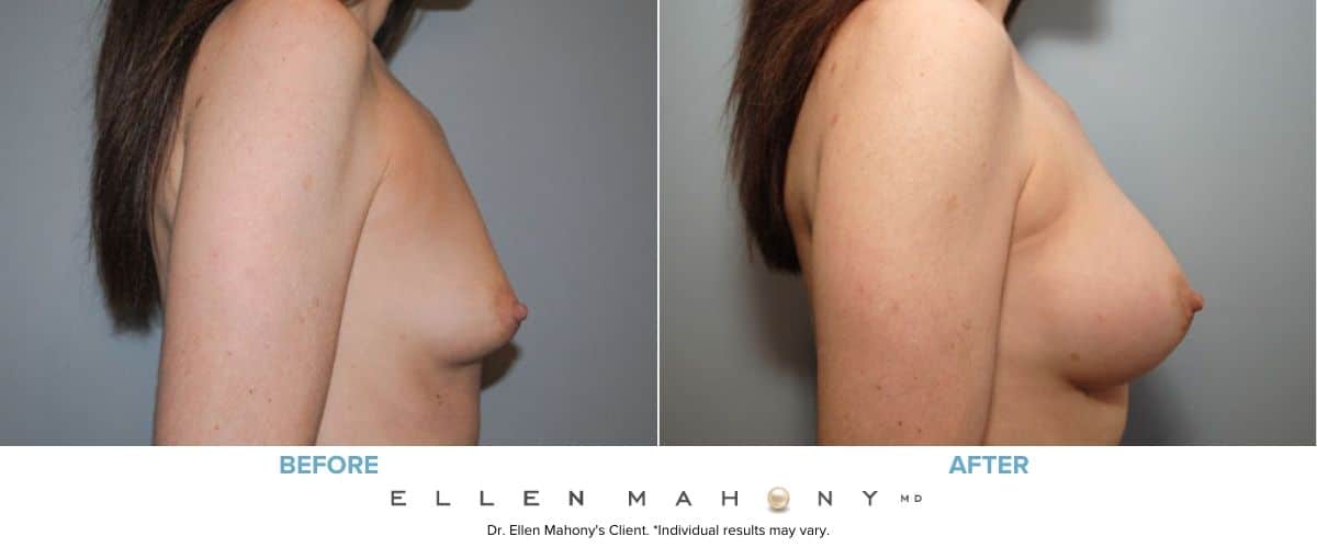 Breast Augmentation Surgery Westport CT
