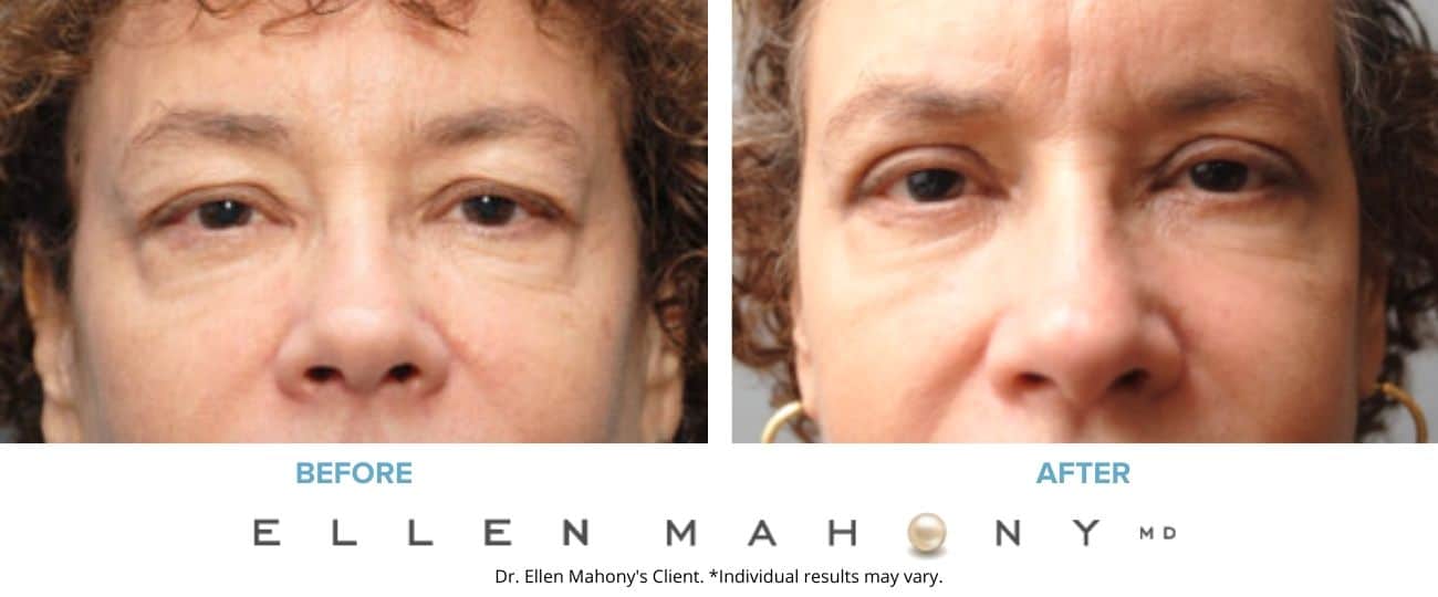 Eyelid Surgery | Westport CT | Dr. Ellen Mahony