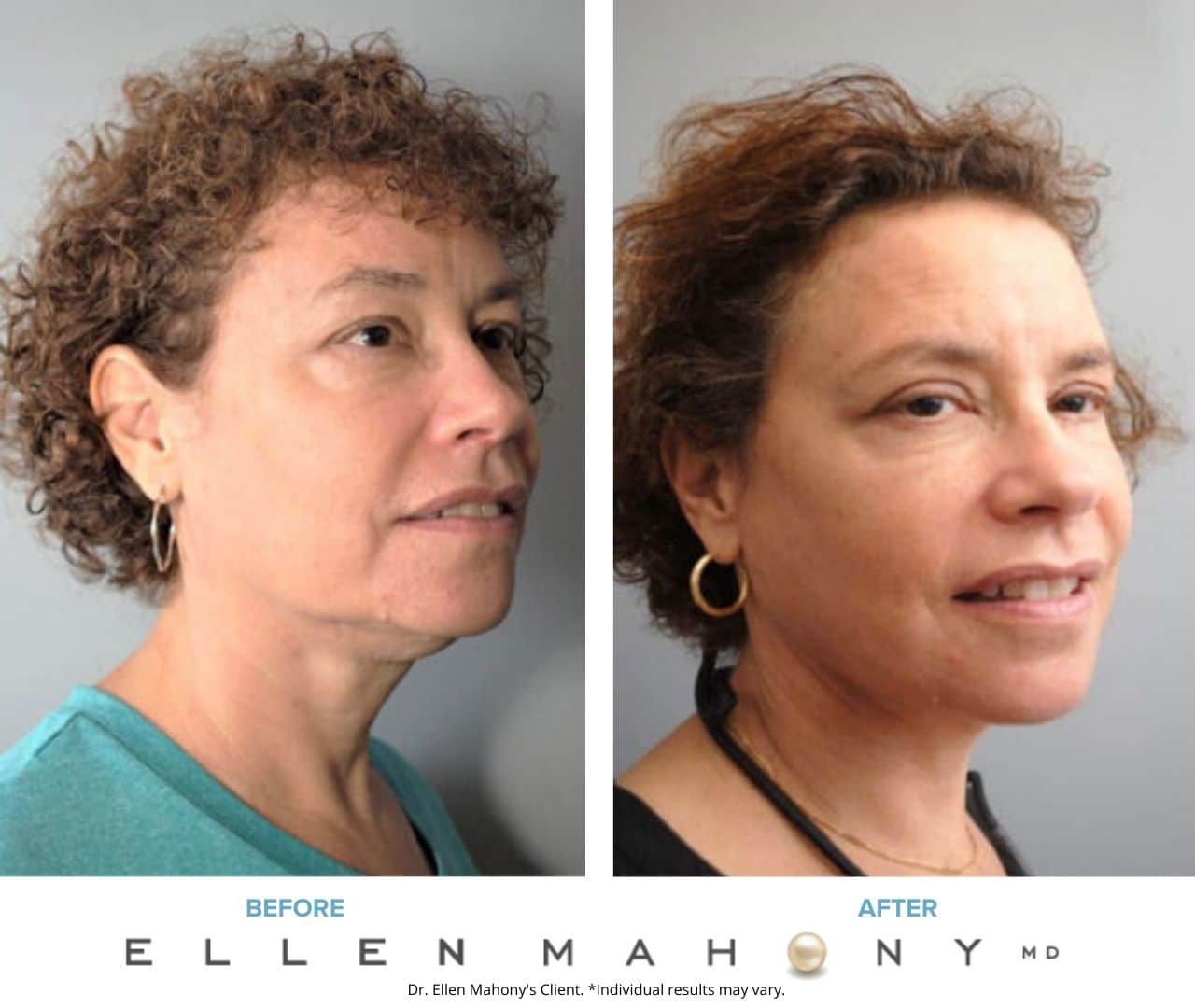 Face Lift/Neck Lift | Westport CT | Dr. Ellen Mahony