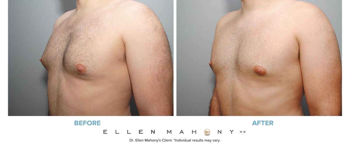 Liposuction for Men Westport CT | Dr. Ellen Mahony