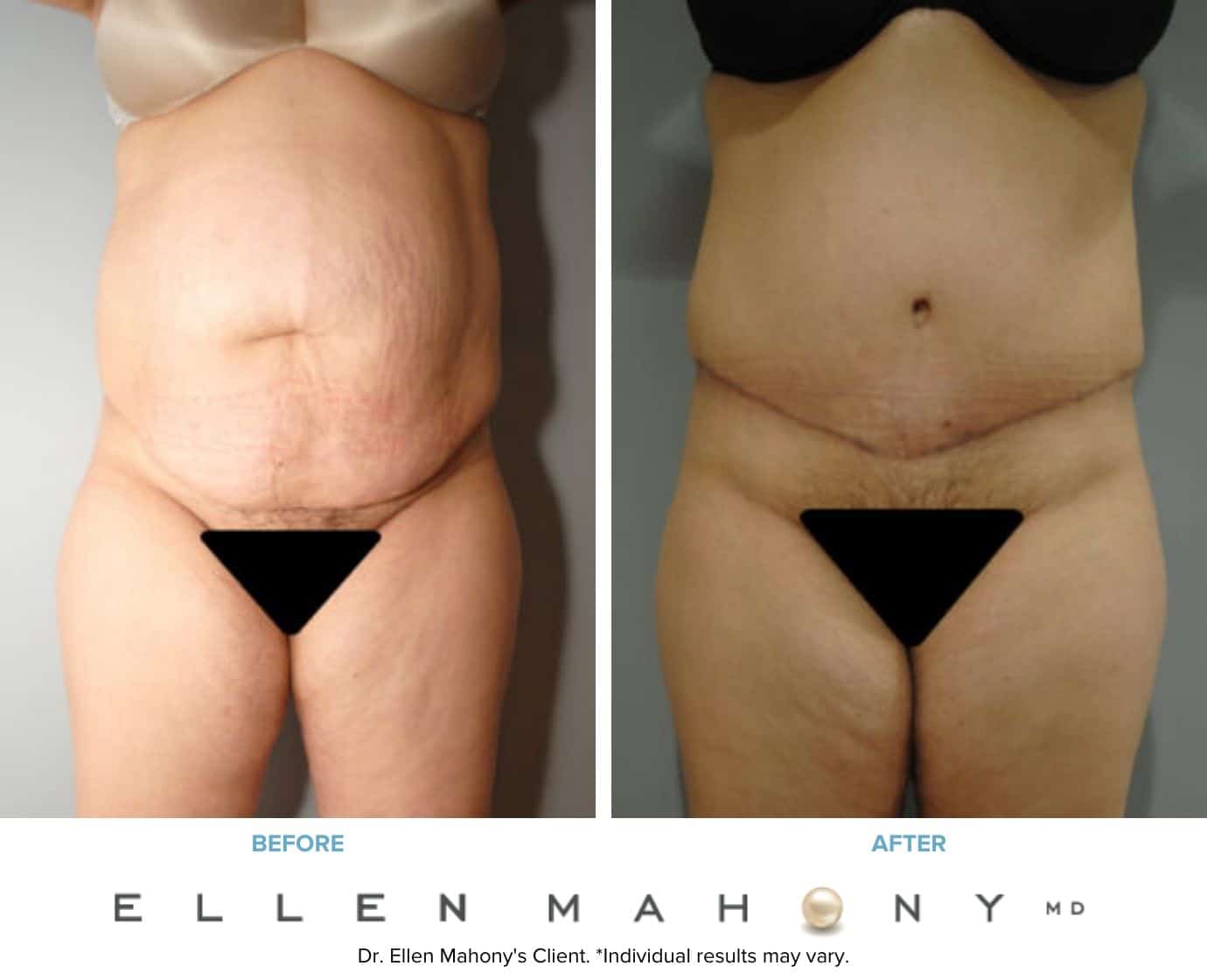 Tummy Tuck Procedures in Westport, CT