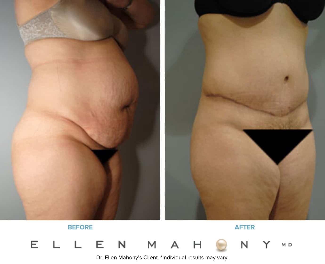 Tummy Tuck | Westport CT | Dr. Ellen Mahony