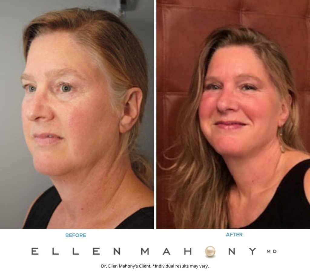 Liposuction Westport CT | Dr. Ellen Mahony