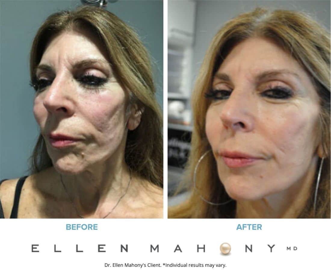 PDO Threads Before & After Images Westport CT