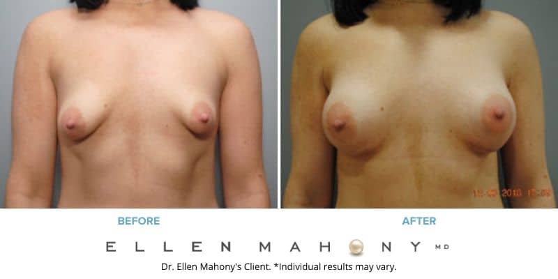 Corrective Breast Surgery | Westport CT | Dr. Ellen Mahony