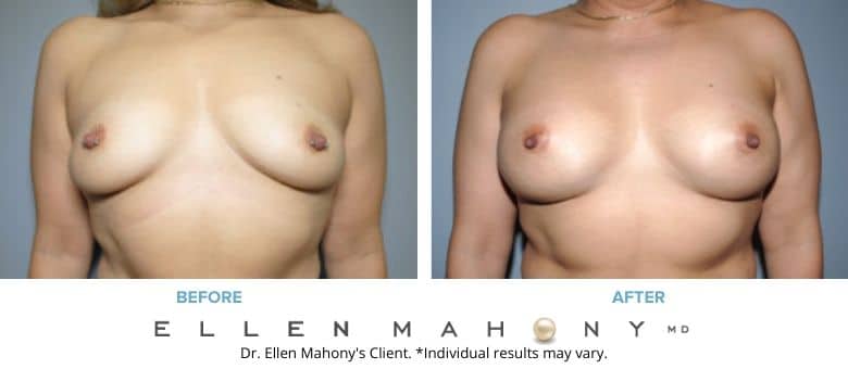 IDEAL Breast Implants | Westport CT | Dr. Ellen Mahony