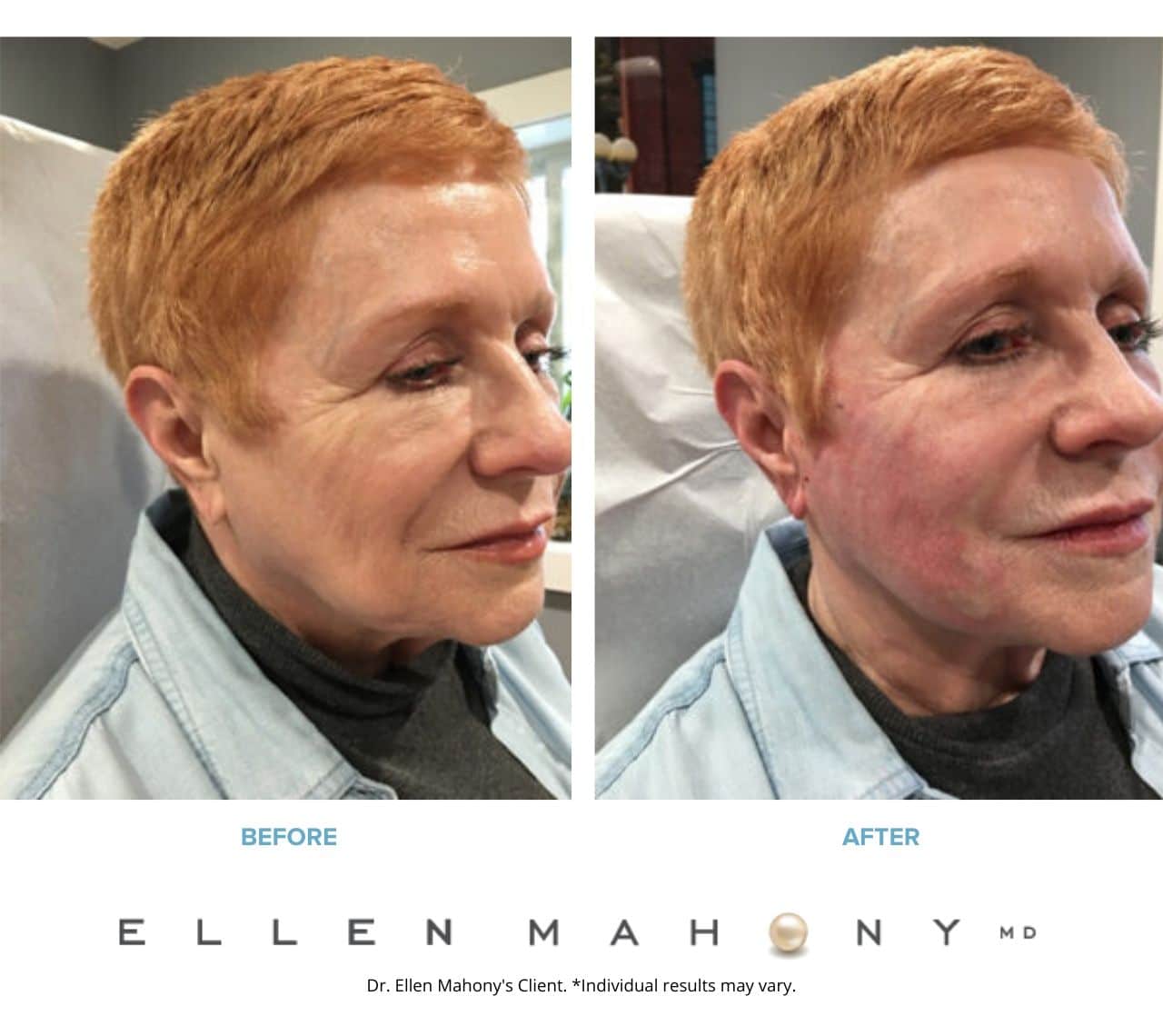 Thread Lift | Westport CT | Dr. Ellen Mahony