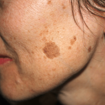 Skin Erase