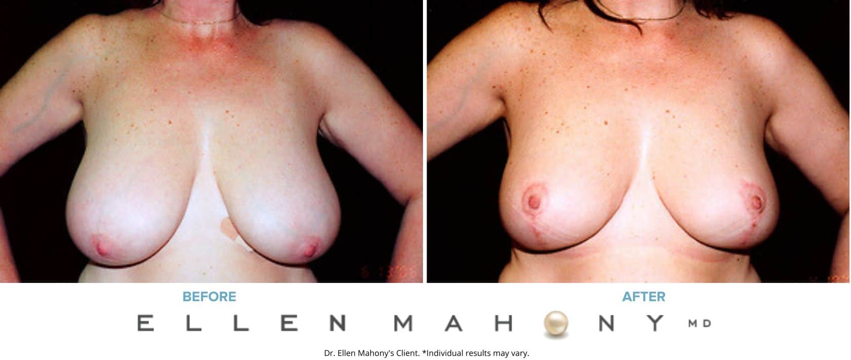 Breast Reduction | Westport CT | Dr. Ellen Mahony