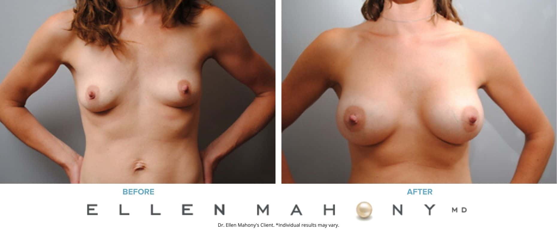 Breast Augmentation | Westport CT | Dr. Ellen Mahony