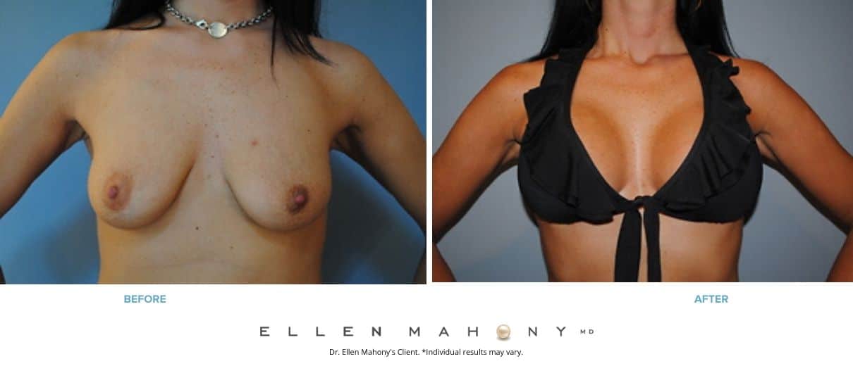 Breast Augmentation and Lift | Westport CT | Dr. Ellen Mahony