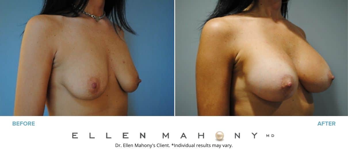 Breast Augmentation and Lift | Westport CT | Dr. Ellen Mahony