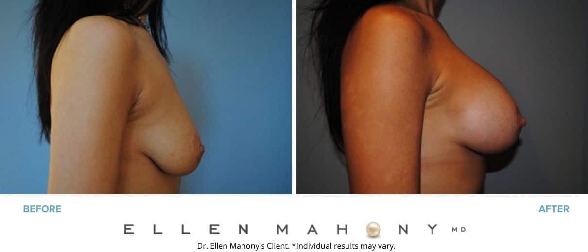 Breast Augmentation and Lift | Westport CT | Dr. Ellen Mahony