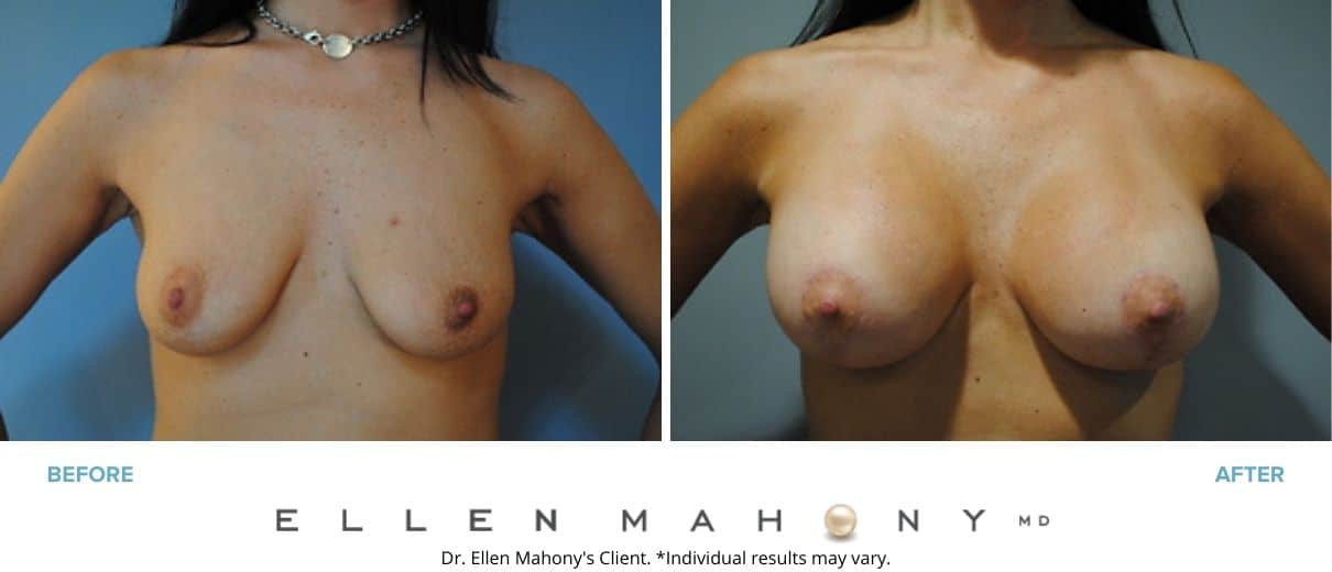 Breast Augmentation and Lift | Westport CT | Dr. Ellen Mahony