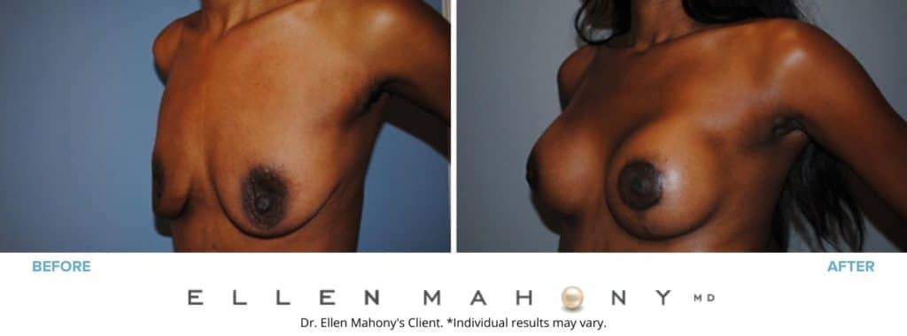 Breast Augmentation and Lift | Westport CT | Dr. Ellen Mahony