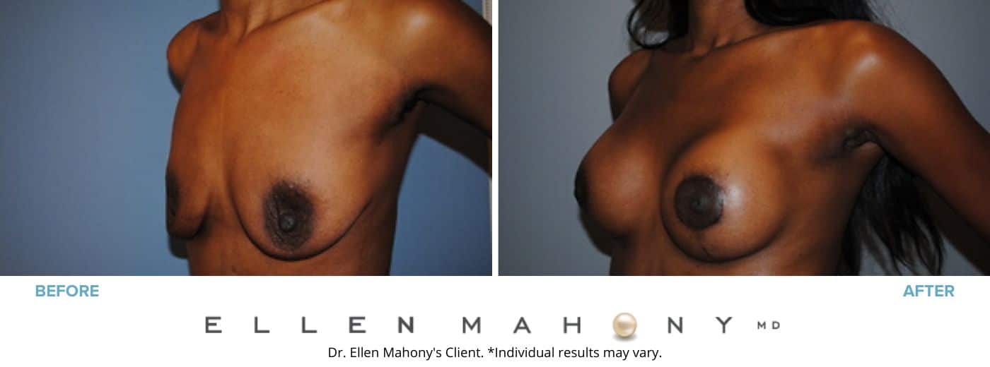 Breast Augmentation and Lift | Westport CT | Dr. Ellen Mahony