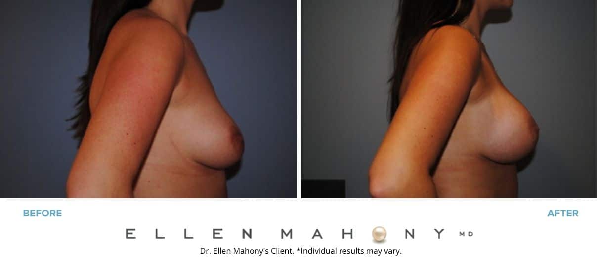 Breast Augmentation | Westport CT | Dr. Ellen Mahony