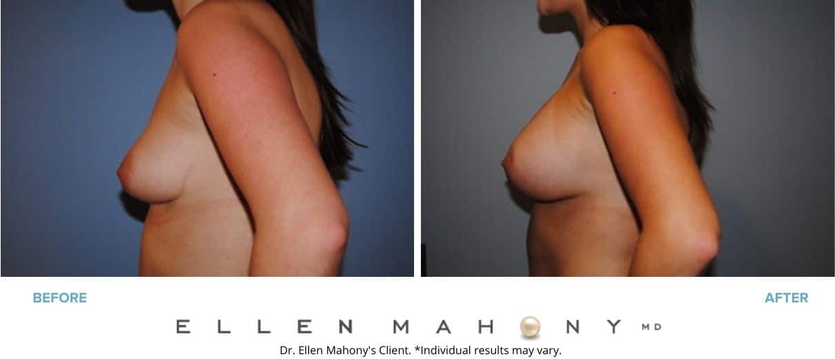 Breast Augmentation | Westport CT | Dr. Ellen Mahony