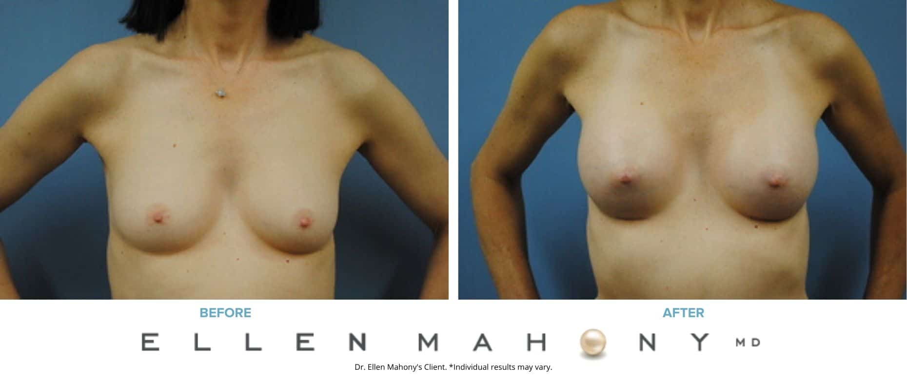 Breast Augmentation | Westport CT | Dr. Ellen Mahony