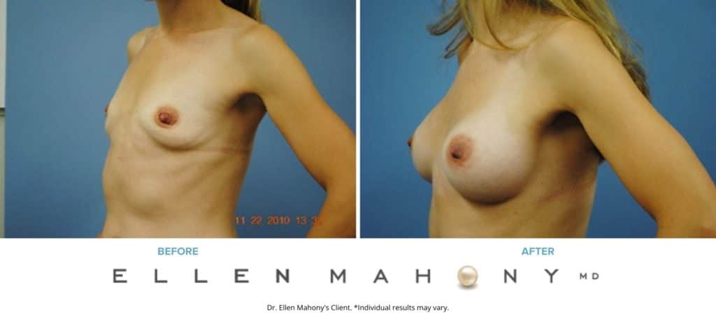 Breast Augmentation | Westport CT | Dr. Ellen Mahony