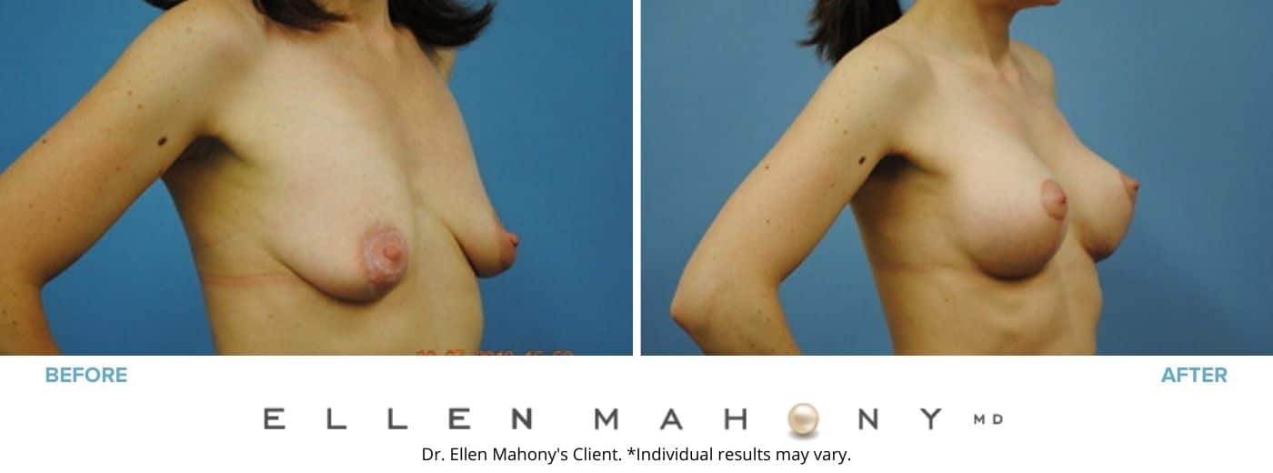 Breast Augmentation and Lift | Westport CT | Dr. Ellen Mahony