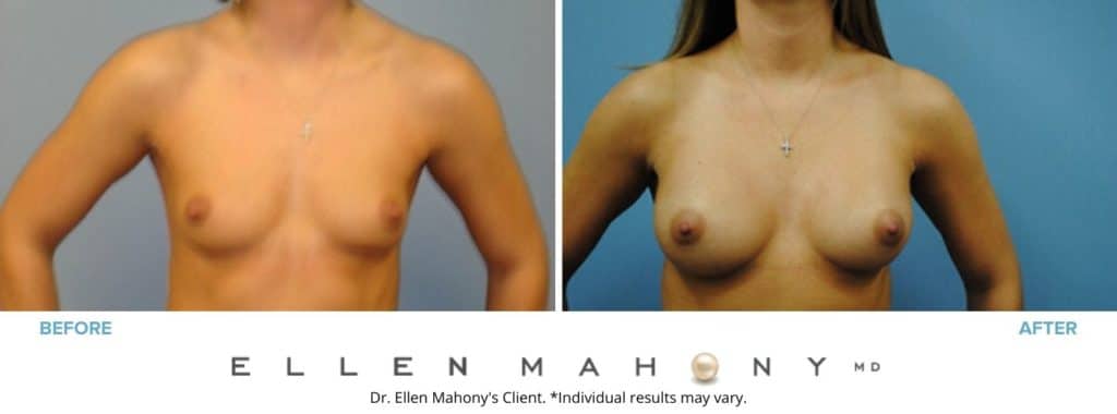 Breast Augmentation | Westport CT | Dr. Ellen Mahony